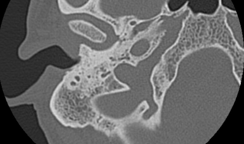 File:Bilateral cholesteatoma (Radiopaedia 54898-61172 Axial bone window 3).jpg