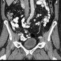 Bilateral direct inguinal herniae (Radiopaedia 17016-16719 A 18).jpg