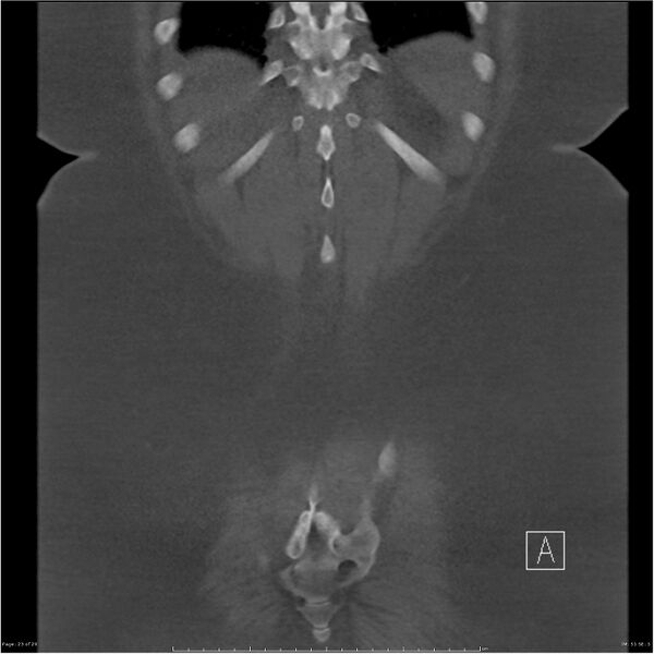 File:Bilateral lumbar ribs (Radiopaedia 25862-26010 Coronal bone window 23).jpg