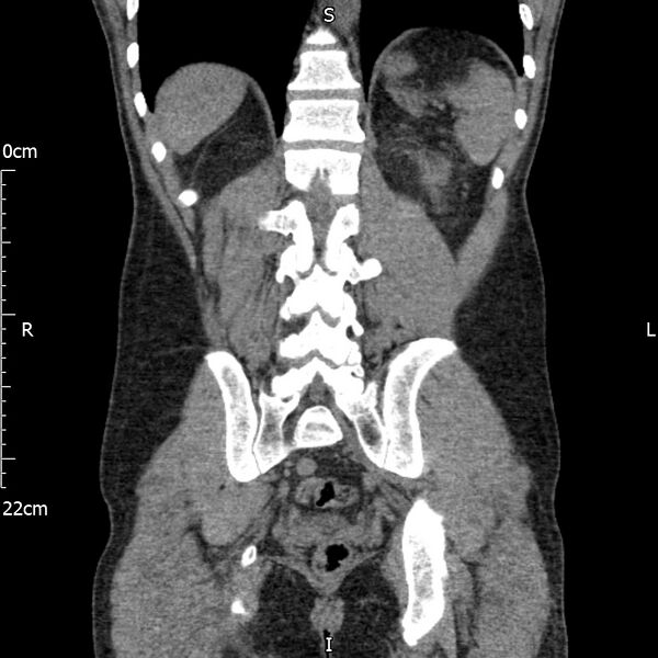 File:Bilateral medullary nephrocalcinosis with ureteric calculi (Radiopaedia 71269-81569 Coronal non-contrast 54).jpg