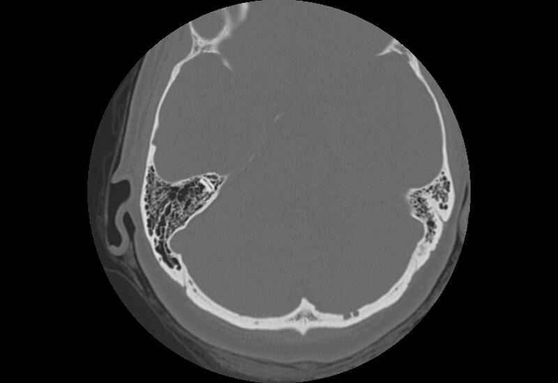 File:Bilateral otospongiosis (Radiopaedia 35447-36940 Axial bone window 47).jpg