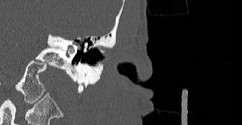 File:Bilateral temporal bone fractures (Radiopaedia 29482-29970 Coronal 251).jpg