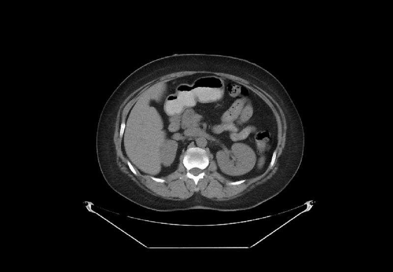 File:Bilateral urolithiasis with incidentally detected splenic artery aneurysm and left inferior vena cava (Radiopaedia 44467-48123 Axial non-contrast 17).jpg