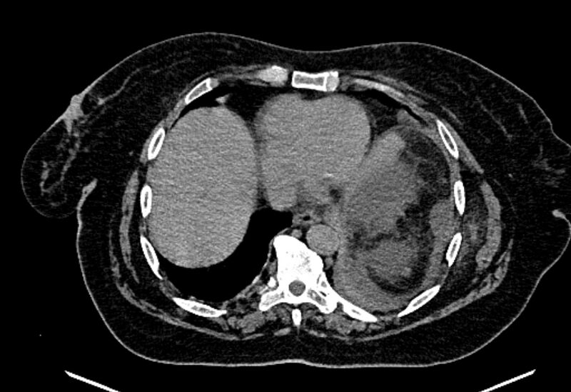 File:Biliary pancreatitis (Radiopaedia 72289-82823 Axial non-contrast 27).jpg
