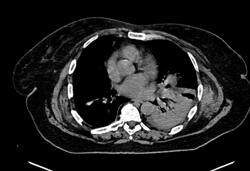 File:Biliary pancreatitis (Radiopaedia 72289-82823 Axial non-contrast 6).jpg