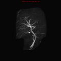 Biliary tree anatomical variant - biliary trifurcation (Radiopaedia 12531-12750 Coronal 3D MRCP 17).jpg