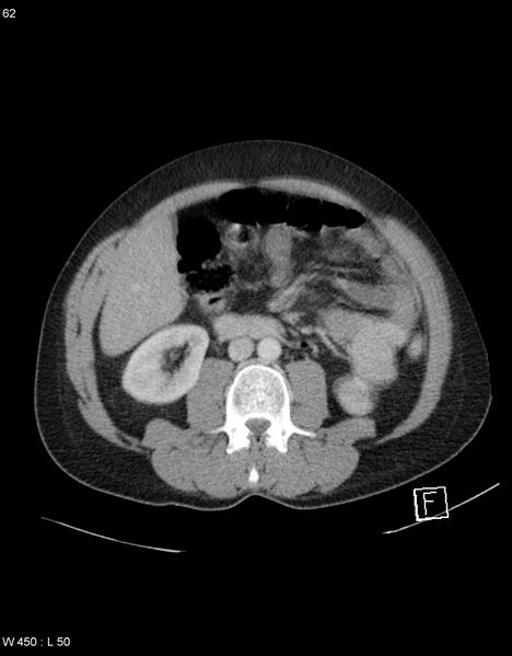 File:Boerhaave syndrome with tension pneumothorax (Radiopaedia 56794-63603 A 31).jpg