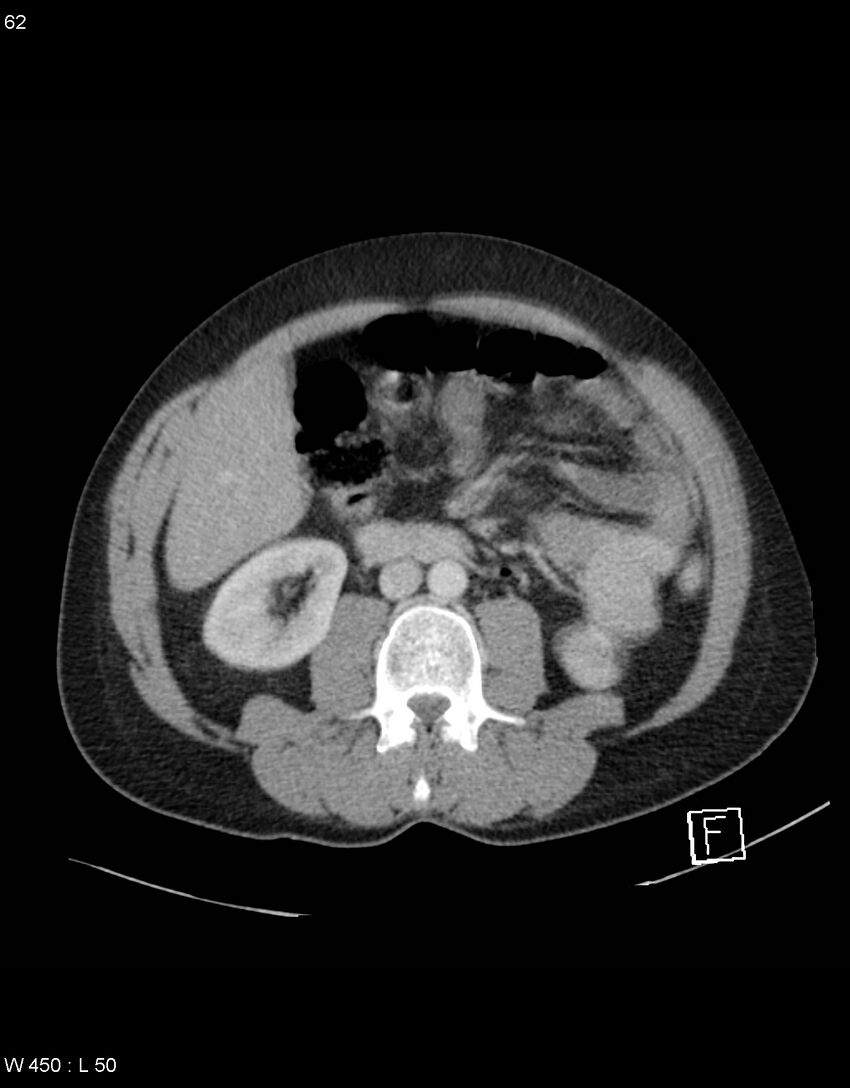 Boerhaave syndrome with tension pneumothorax (Radiopaedia 56794-63603 A 31).jpg