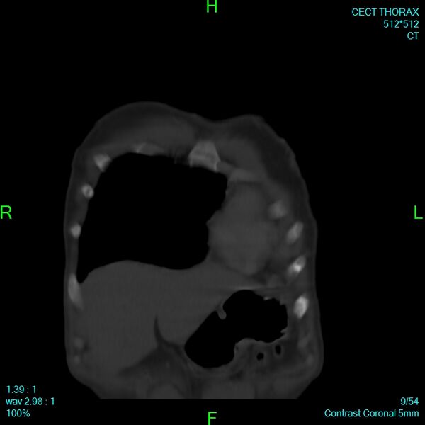 File:Bone metastases from lung carcinoma (Radiopaedia 54703-60937 Coronal bone window 9).jpg