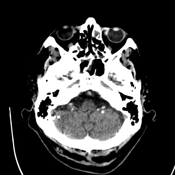 File:Brain Pantopaque remnants (Radiopaedia 78403-91048 Axial non-contrast 27).jpg