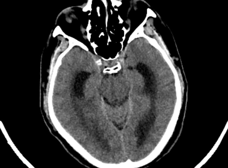 File:Brain abscess complicated by intraventricular rupture and ventriculitis (Radiopaedia 82434-96575 Axial non-contrast 11).jpg