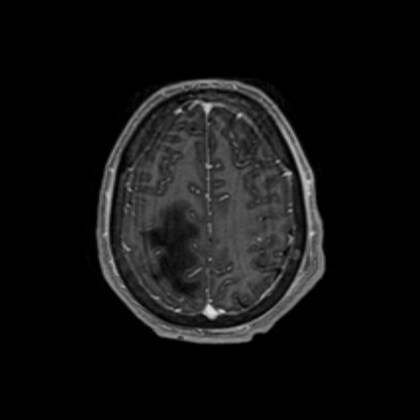 Brain abscess complicated by intraventricular rupture and ventriculitis (Radiopaedia 82434-96577 Axial T1 C+ 57).jpg