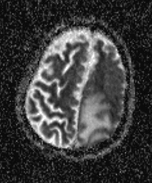 File:Brain abscess with dual rim sign (Radiopaedia 87566-103938 Axial ADC 16).jpg