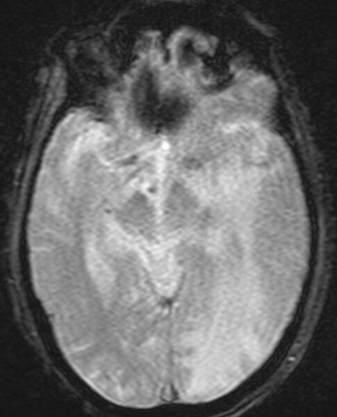 File:Brain abscess with dual rim sign (Radiopaedia 87566-103938 Axial SWI 10).jpg