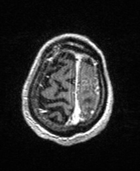 File:Brain abscess with dual rim sign (Radiopaedia 87566-103938 Axial T1 C+ 143).jpg