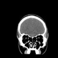 Brain death (Radiopaedia 78597-91360 Coronal non-contrast 18).jpg