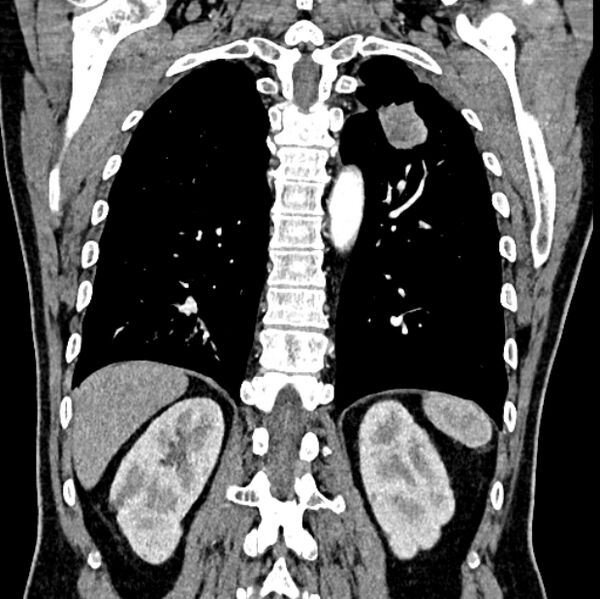 File:Brain metastases - lung cancer primary (Radiopaedia 75060-86116 C+ arterial phase 51).jpg