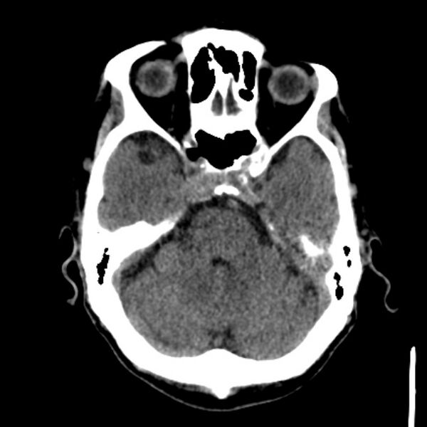 File:Brain metastases from lung cancer (Radiopaedia 27849-28092 Axial non-contrast 15).jpg