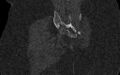 Breast carcinoma with pathological hip fracture (Radiopaedia 60314-67993 Coronal bone window 91).jpg