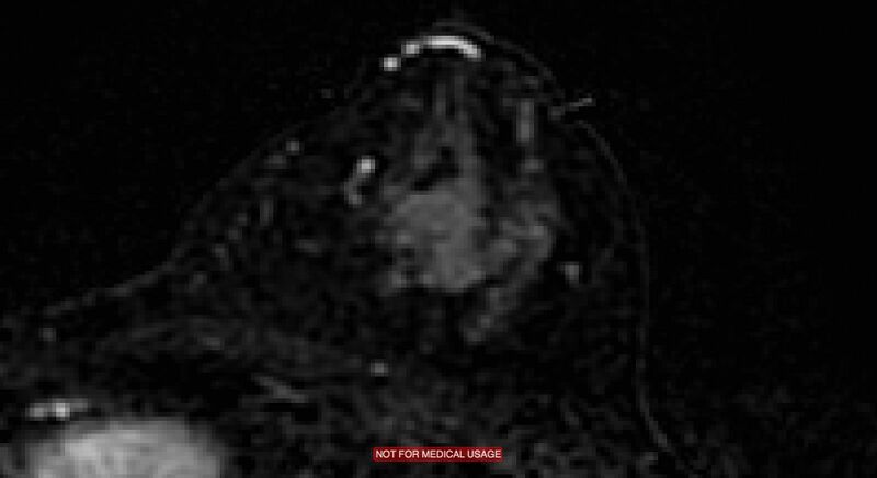 File:Breast lymphoma (MRI) (Radiopaedia 34999-36498 C 1).jpg