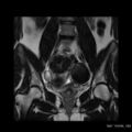 Broad ligament fibroid (Radiopaedia 49135-54241 Coronal T2 14).jpg