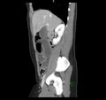 Broad ligament hernia (Radiopaedia 63260-71832 C 18).jpg