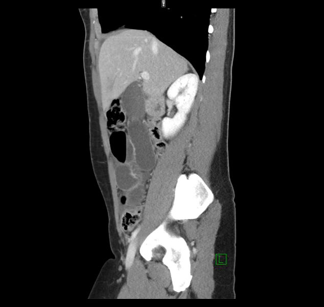 File:Broad ligament hernia (Radiopaedia 63260-71832 C 18).jpg
