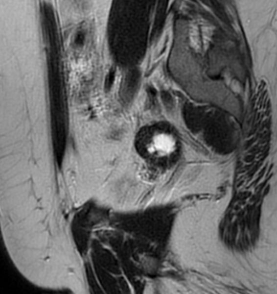 File:Broad ligament leiomyoma (Radiopaedia 81634-95516 Sagittal T2 8).jpg