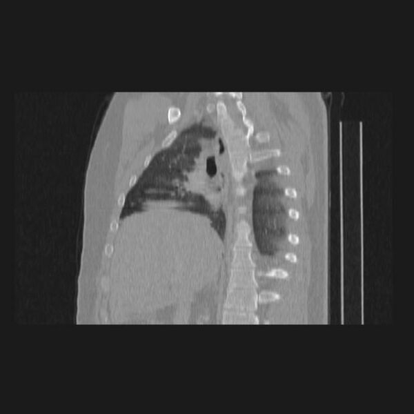 File:Bronchial atresia (Radiopaedia 60685-68439 Sagittal lung window 37).jpg