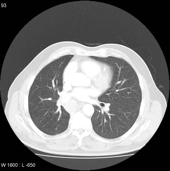 File:Bronchial carcinoid tumor with right lower lobe collapse (Radiopaedia 29060-29422 B 31).jpg
