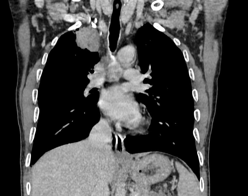 Bronchogenic carcinoma with superior vena cava syndrome (Radiopaedia 36497-38054 Coronal C+ delayed 40).jpg