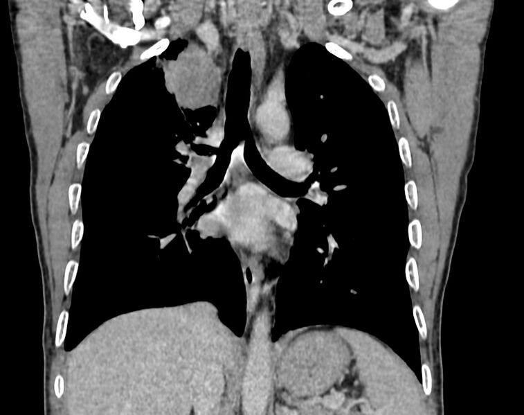 File:Bronchogenic carcinoma with superior vena cava syndrome (Radiopaedia 36497-38054 Coronal C+ delayed 53).jpg