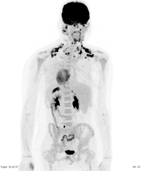 File:Brown fat uptake (FDG PET-CT) (Radiopaedia 77392-89513 MIP 32).jpg