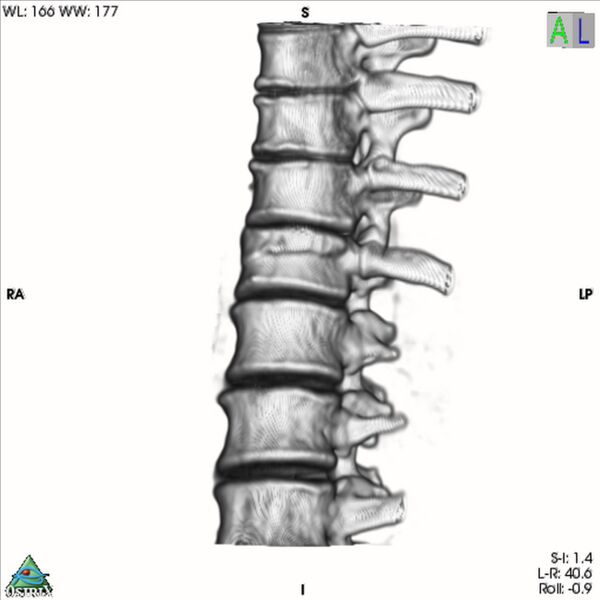 File:Bulging of paraspinal line in traumatic thoracal spinal compression fracture (Radiopaedia 29221-35872 3D VR 16).jpg