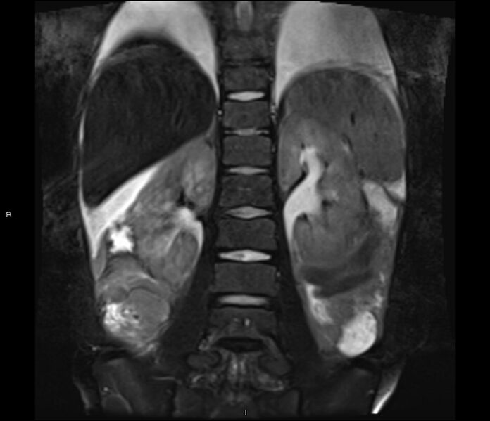 File:Burkitt lymphoma (bowel) (Radiopaedia 68839-78557 Coronal STIR 19).jpg