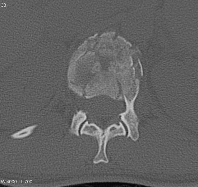 File:Burst fracture (Radiopaedia 5274-7018 Axial bone window 4).jpg