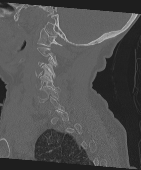 File:C2 fracture with vertebral artery dissection (Radiopaedia 37378-39199 Sagittal bone window 54).png