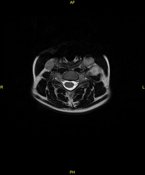 File:C5 nerve sheath tumor (Radiopaedia 85777-101596 Axial T2 33).jpg