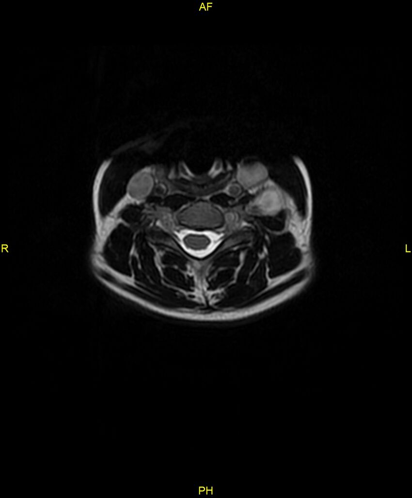 C5 nerve sheath tumor (Radiopaedia 85777-101596 Axial T2 33).jpg