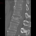 Calcaneal fracture and associated spinal injury (Radiopaedia 17896-17658 Sagittal bone window 1).jpg