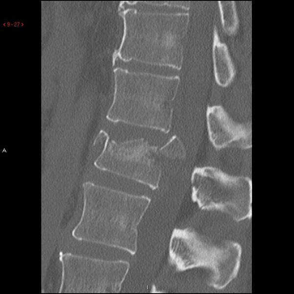 File:Calcaneal fracture and associated spinal injury (Radiopaedia 17896-17658 Sagittal bone window 1).jpg