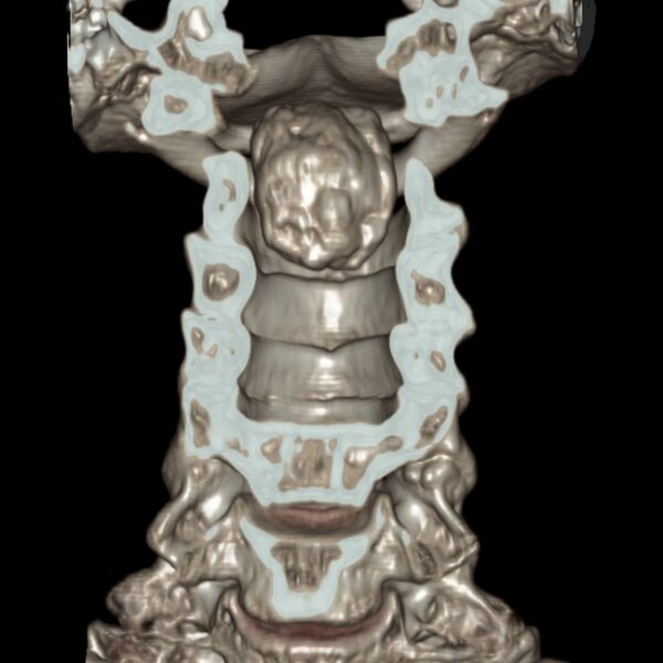File:Calcified meningioma - cervical canal (Radiopaedia 70136-80171 3D-VR 4).jpg