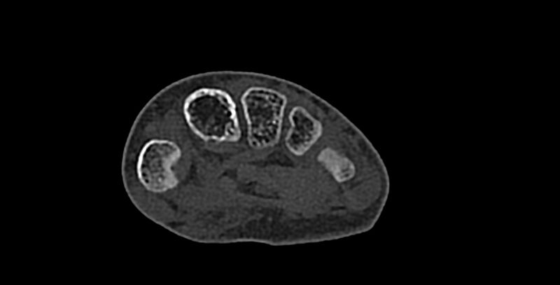 File:Calcifying aponeurotic fibroma (Radiopaedia 88423-105064 Axial bone window 126).jpg