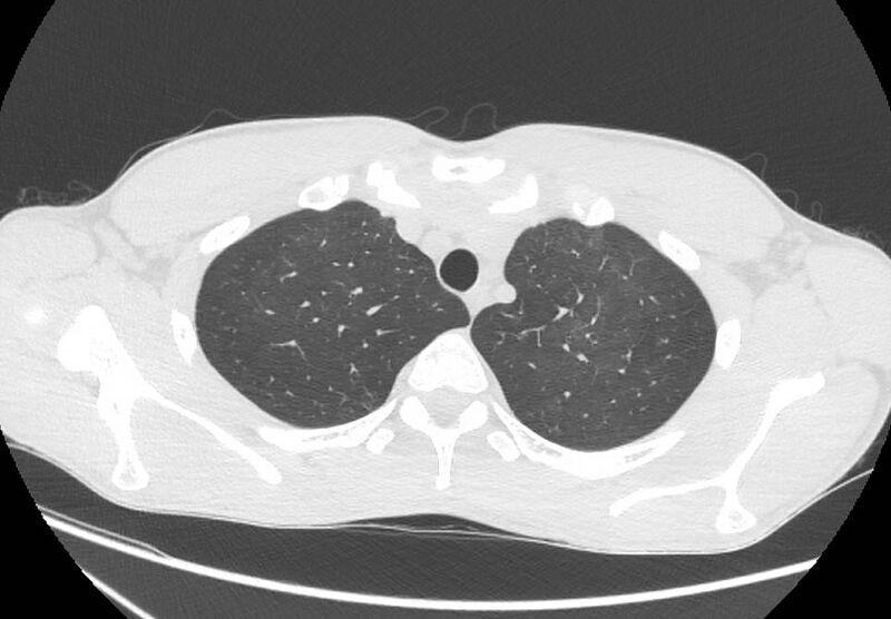File:Cannabis-induced diffuse alveolar hemorrhage (Radiopaedia 89834-106946 Axial lung window 19).jpg
