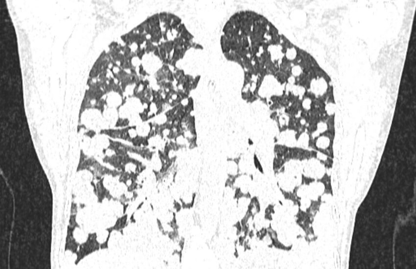 Cannonball metastases from breast cancer (Radiopaedia 91024-108569 Coronal lung window 92).jpg