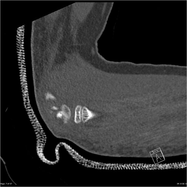 File:Capitellum fracture (Radiopaedia 23352-23426 Sagittal bone window 7).jpg