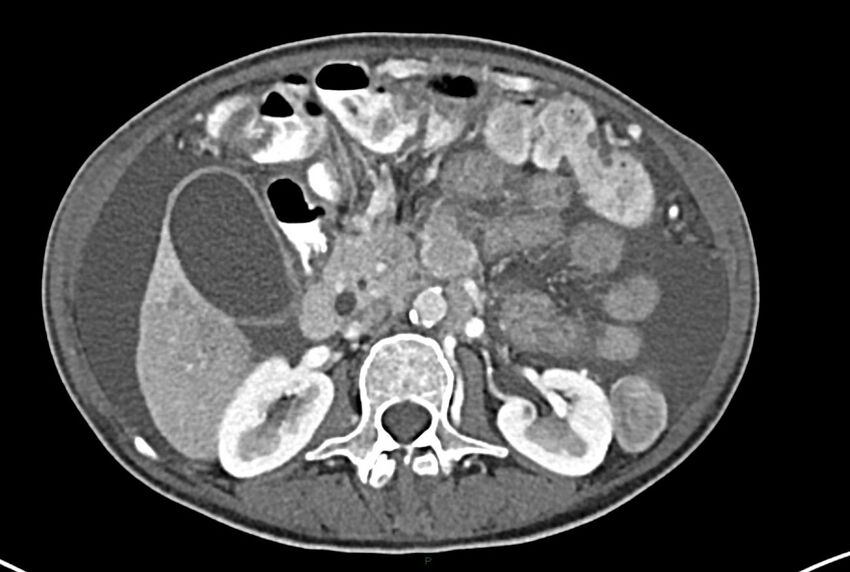Carcinoid mesenteric tumor complicated by chylous ascites (Radiopaedia 76312-87953 A 29).jpg