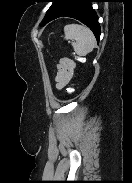 File:Carcinoid tumor - terminal ileum (Radiopaedia 60931-68739 C 5).jpg