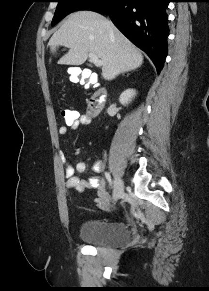 File:Carcinoid tumor - terminal ileum (Radiopaedia 60931-68739 C 62).jpg