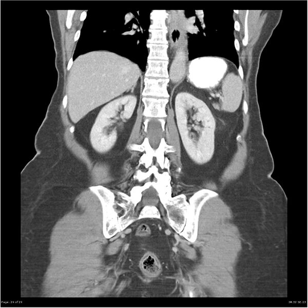 File:Carcinoid tumor of the ileum with metastasis to orbit (Radiopaedia 28165-28425 B 24).jpg
